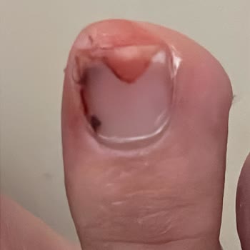 Lacoste Spor Ayakkabısında Şiddetli Ayak Ağrısı Ve Tırnak Kanaması