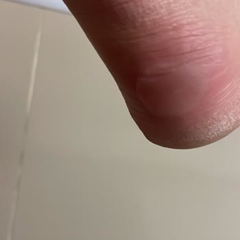 Lacoste Spor Ayakkabısında Şiddetli Ayak Ağrısı Ve Tırnak Kanaması