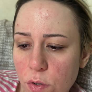 Brimoder İlacının Şiddetli Yüz Kızarıklığı Ve Psikolojik Etkileri