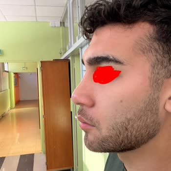 Op. Dr. Hüseyin Karabulut Rinoplasti Sonrası Asimetrik Burun ve Nefes Alma Sorunları