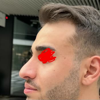 Op. Dr. Hüseyin Karabulut Rinoplasti Sonrası Asimetrik Burun ve Nefes Alma Sorunları