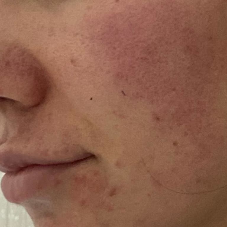 Brimoder İlacının Rosacea Tedavisinde Şiddetli Yan Etkileri Ve Acil İnceleme Talebi