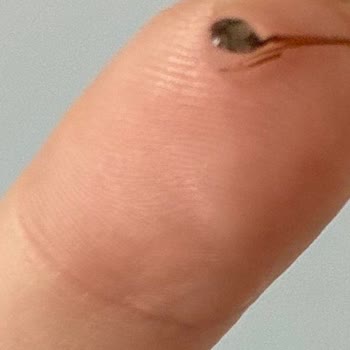 Damacana Suyunda Görülen Siyah Jelimsi Yabancı Madde Ve Şiddetli Karın Ağrısı