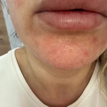 Rozasea Hastası Hassas Ciltte Bioderma Ürünleri Yanma Ve Tahrişe Neden Oldu