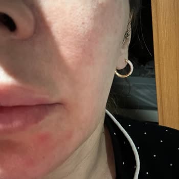 Rozasea Hastası Hassas Ciltte Bioderma Ürünleri Yanma Ve Tahrişe Neden Oldu