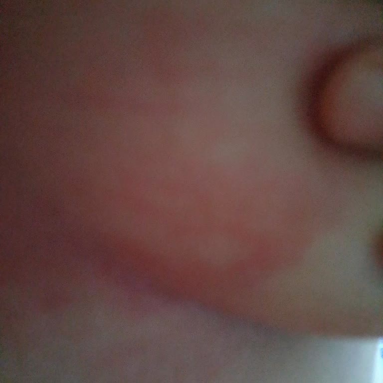 Bingo Konsantre Yumuşatıcının Ciltte Alerjik Reaksiyonları Ve Fiş Olmadan İade Talebi