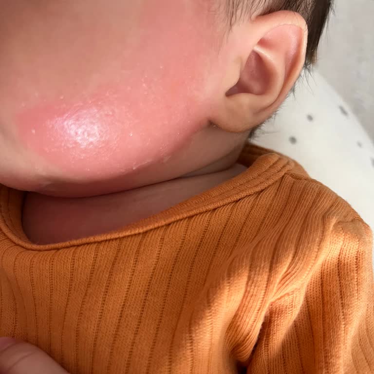 Uni Baby Yenidoğan Islak Pamuk Mendilinde Bebek Yüzünde Şiddetli Kızarıklık