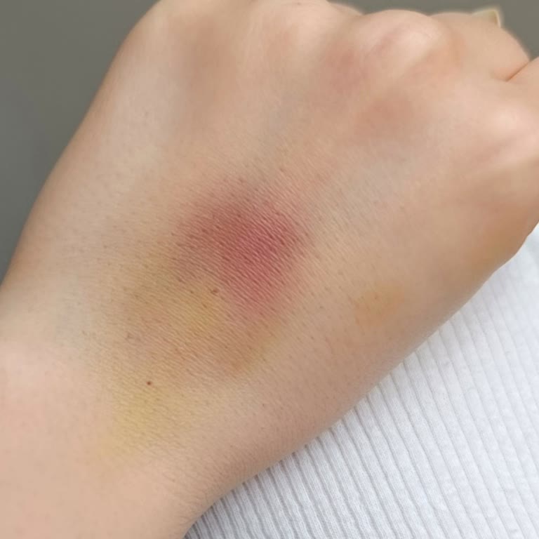 Medipol Bahçelievler Hastanesi Hemşirenin Hatalı İşlemi Sonucunda Damarım Patladı