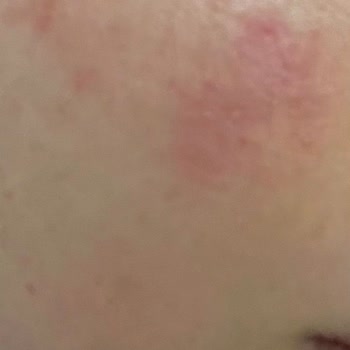 Dr. Althea 345 Kremi Alerjik Reaksiyon Ve İade Talebinin Reddi