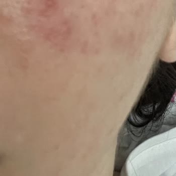 Dr. Althea 345 Kremi Alerjik Reaksiyon Ve İade Talebinin Reddi