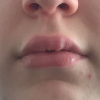 Elasty Dudak Dolgusu Sonrası Şişlik Ve Şekilsizlik, 3.000 TL İadesi Talebi