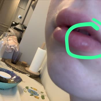 Elasty Dudak Dolgusu Sonrası Şişlik Ve Şekilsizlik, 3.000 TL İadesi Talebi