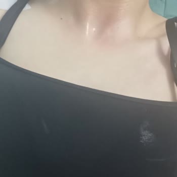 Doğalgaz Kaçağı Ve Yangın Nedeniyle Aile Üyesi Yanıklar Yaşadı