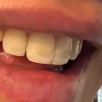 Dentapros Tunalı Ankara Şubesinde Dolguların Kısa Sürede Düşmesi Ve Ücret İadesi Talebi