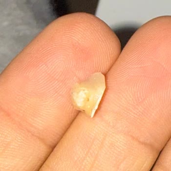 Dentapros Tunalı Ankara Şubesinde Dolguların Kısa Sürede Düşmesi Ve Ücret İadesi Talebi