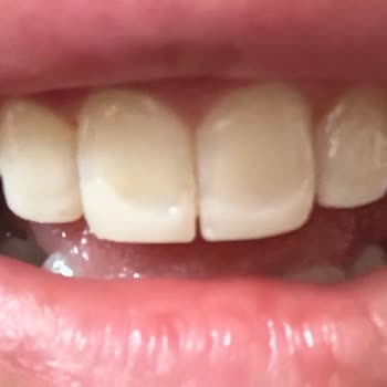 Dentapros Tunalı Ankara Şubesinde Dolguların Kısa Sürede Düşmesi Ve Ücret İadesi Talebi