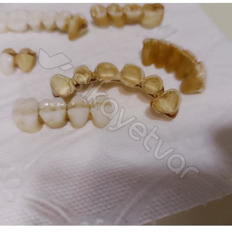 Master Dent Ağız Ve Diş Polikliniği Zirkonyum Kaplamalarda Ağrı, Estetik Sorunları,