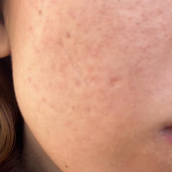 Watsons'ta Satın Alınan Neutrogena Yüz Temizleme Jelinin Şiddetli Alerjik Reaksiyonu Ve Sağlık Masraflarının Karşılanması Talebi