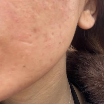 Watsons'ta Satın Alınan Neutrogena Yüz Temizleme Jelinin Şiddetli Alerjik Reaksiyonu Ve Sağlık Masraflarının Karşılanması Talebi