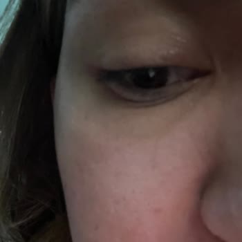 Watsons'ta Satın Alınan Neutrogena Yüz Temizleme Jelinin Şiddetli Alerjik Reaksiyonu Ve Sağlık Masraflarının Karşılanması Talebi