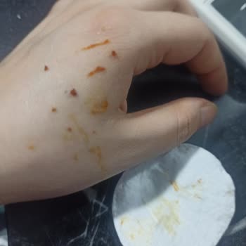 Dermatolog Uyarıyor Bozulmuş Cilt Kremi Alerjik Reaksiyona Neden Oldu