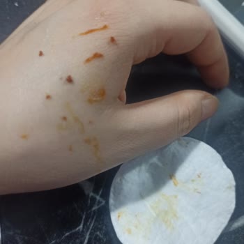 Dermatolog Uyarıyor Bozulmuş Cilt Kremi Alerjik Reaksiyona Neden Oldu