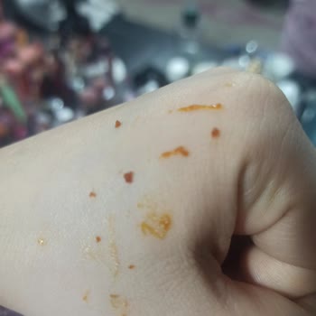 Dermatolog Uyarıyor Bozulmuş Cilt Kremi Alerjik Reaksiyona Neden Oldu