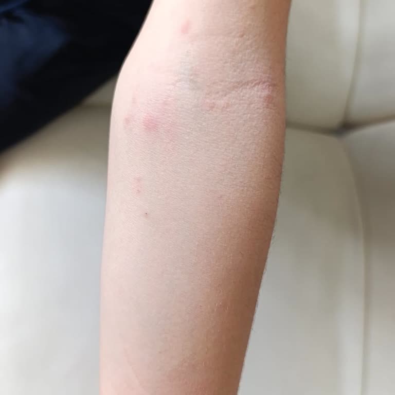 Klomaks Şurubu Çocukta Cilt Döküntüsü Yaratması Nedeniyle Güvenlik İncelemesi İsteniyor