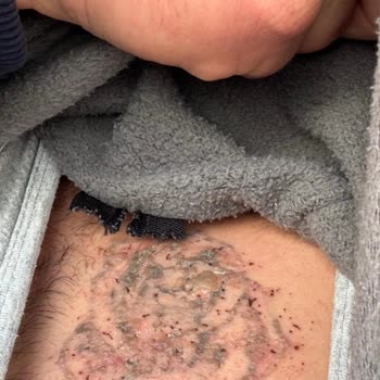 Suit Güzellik Merkezleri Dövme Silme İşleminde Yanık Ve Skar, Kamuflaj Ücretinin İadesi Talebi