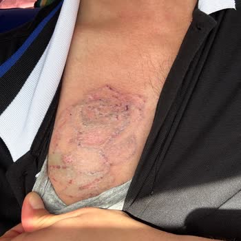 Suit Güzellik Merkezleri Dövme Silme İşleminde Yanık Ve Skar, Kamuflaj Ücretinin İadesi Talebi