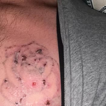 Suit Güzellik Merkezleri Dövme Silme İşleminde Yanık Ve Skar, Kamuflaj Ücretinin İadesi Talebi