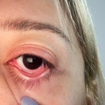 Yıldızca Beauty İpek Kirpik Uygulaması Sonrası Göz Ağrısı ve Şişmesi Nedeniyle Ücret İadesi Talebi