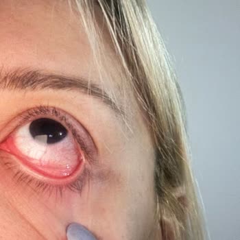 Yıldızca Beauty İpek Kirpik Uygulaması Sonrası Göz Ağrısı ve Şişmesi Nedeniyle Ücret İadesi Talebi