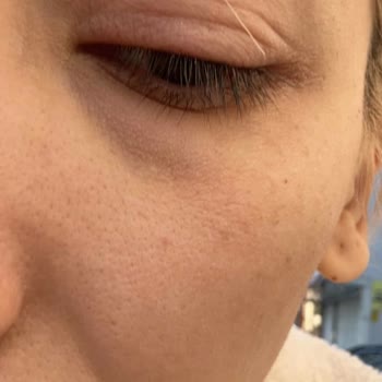 Yıldızca Beauty İpek Kirpik Uygulaması Sonrası Göz Ağrısı ve Şişmesi Nedeniyle Ücret İadesi Talebi