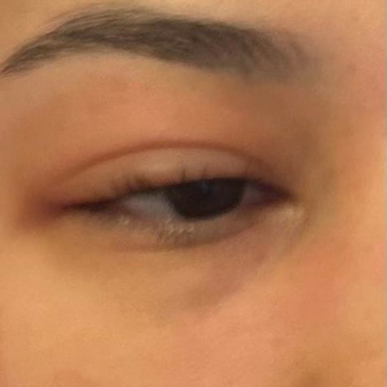 Epilady Kişisel Bakım Salonu Kirpik Liftinginde Göz Kapağı Yanığı ve Hijyen Eksikliği