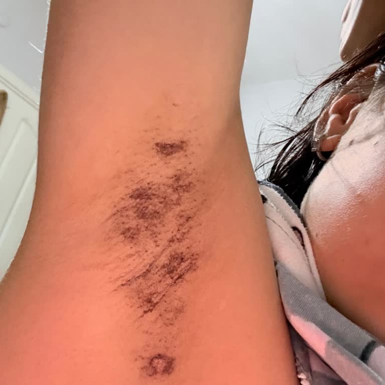 Lazer Epilasyon Sonrası Açık Yanıklar Ve Bilgi Verilmemesi