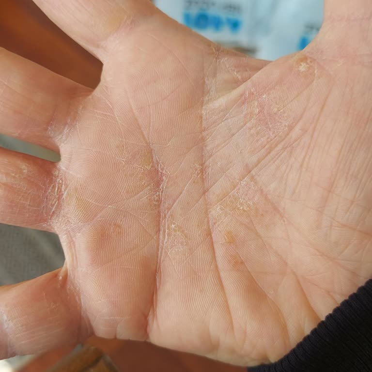 Dalan Banyo Sabunları Nedeniyle Şiddetli Dermatit Ve Ağır Mağduriyet