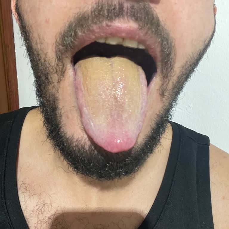 Sensodyne Diş Macununda Dil Yarası Ve Sararma