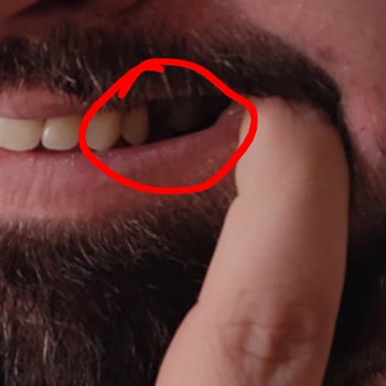 Milka Çikolatasındaki Yabancı Cisim Diş Hasarına Neden Oldu
