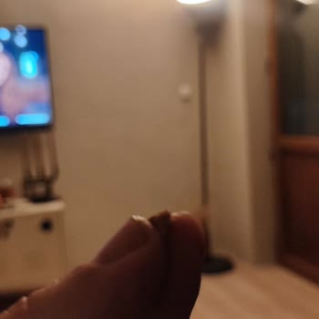 Milka Çikolatasındaki Yabancı Cisim Diş Hasarına Neden Oldu