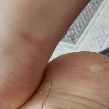 Dakota Ayakkabısının Kısa Sürede Ayağa Vurması Ve Sol Tekin Deforme Olması