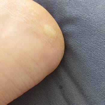 Dakota Ayakkabısının Kısa Sürede Ayağa Vurması Ve Sol Tekin Deforme Olması