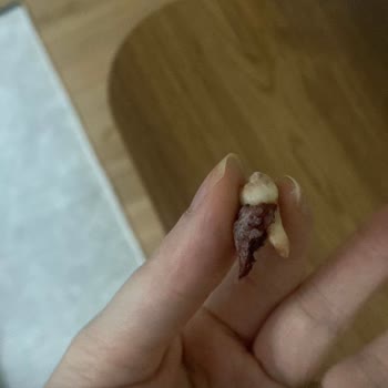 Özel Dent Tower Ağız Ve Diş Sağlığı Polikliniği Kaplamalar Yanlış Uygulandı