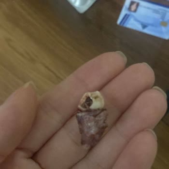 Özel Dent Tower Ağız Ve Diş Sağlığı Polikliniği Kaplamalar Yanlış Uygulandı