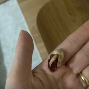 Özel Dent Tower Ağız Ve Diş Sağlığı Polikliniği Kaplamalar Yanlış Uygulandı