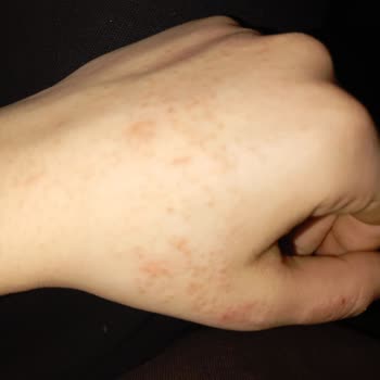İzmir Bayraklı Şehir Hastanesi Dermatoloji Bölümünde Yanlış Teşhis Ve Zararlı Tedavi