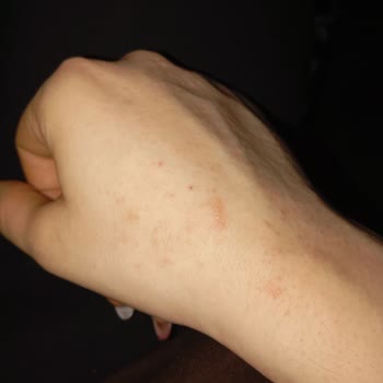 İzmir Bayraklı Şehir Hastanesi Dermatoloji Bölümünde Yanlış Teşhis Ve Zararlı Tedavi