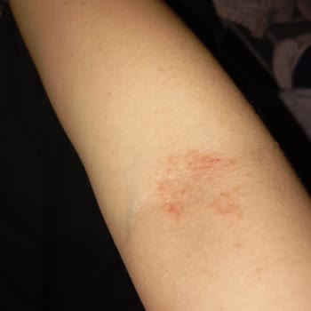 İzmir Bayraklı Şehir Hastanesi Dermatoloji Bölümünde Yanlış Teşhis Ve Zararlı Tedavi