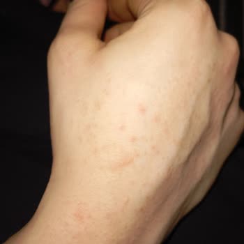 İzmir Bayraklı Şehir Hastanesi Dermatoloji Bölümünde Yanlış Teşhis Ve Zararlı Tedavi