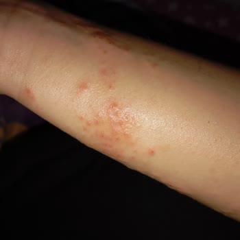 İzmir Bayraklı Şehir Hastanesi Dermatoloji Bölümünde Yanlış Teşhis Ve Zararlı Tedavi